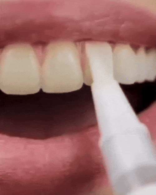 Stylo De Blanchiment Dentaire V2.0