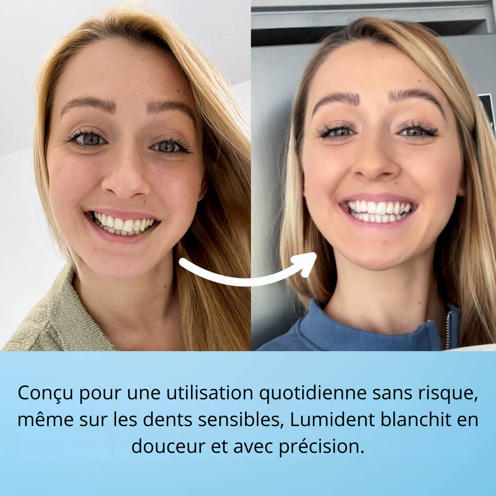 Stylo De Blanchiment Dentaire V2.0